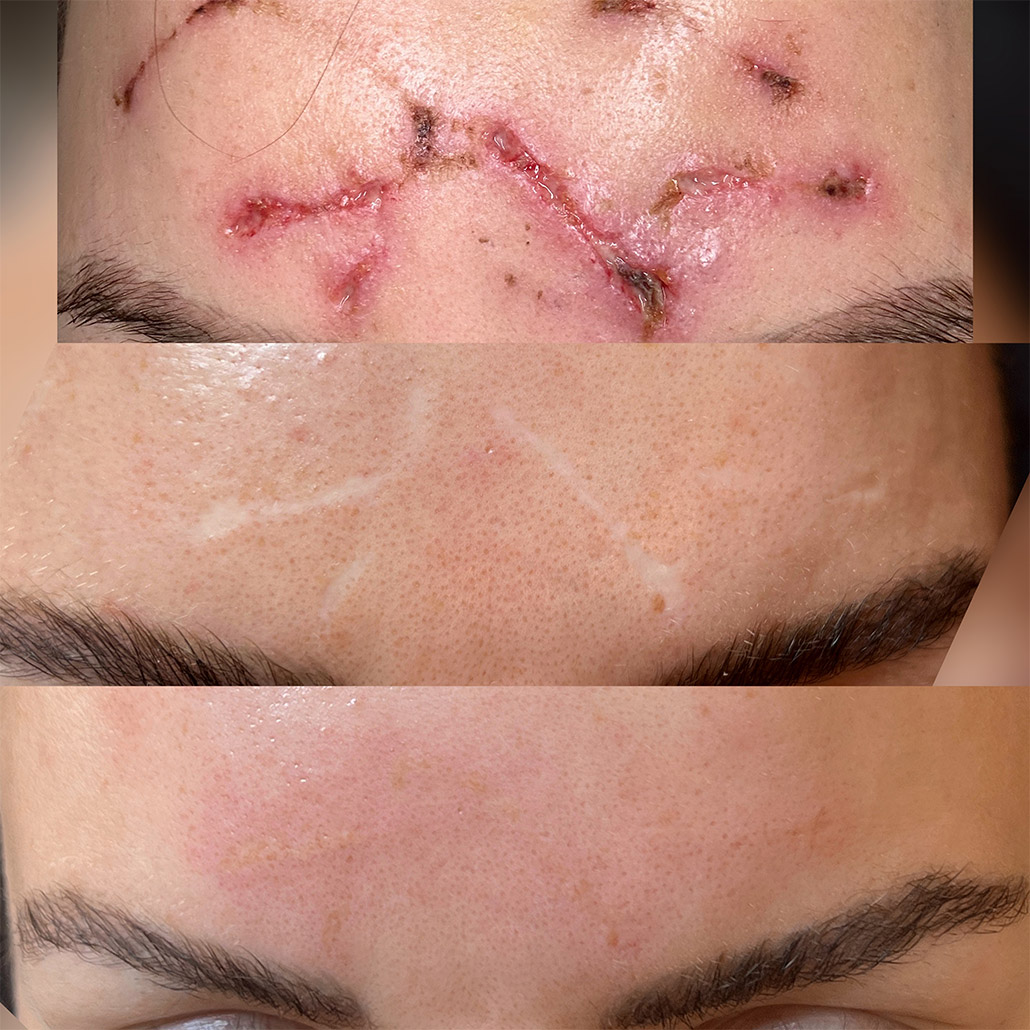 Medizinische Pigmentierung Permanent Make-up Köln - Sara Pavo