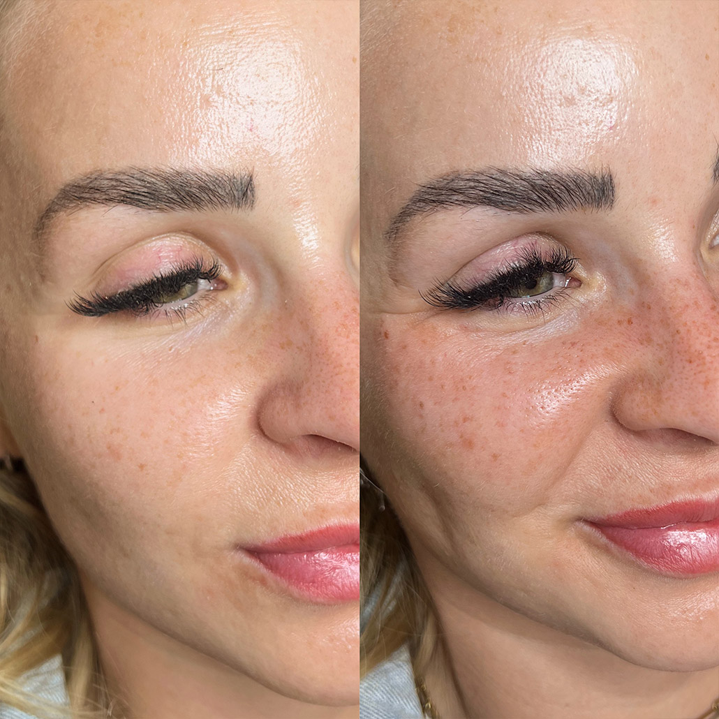 Sommersprossen PMU | Permanent Make-up Köln - Sara Pavo