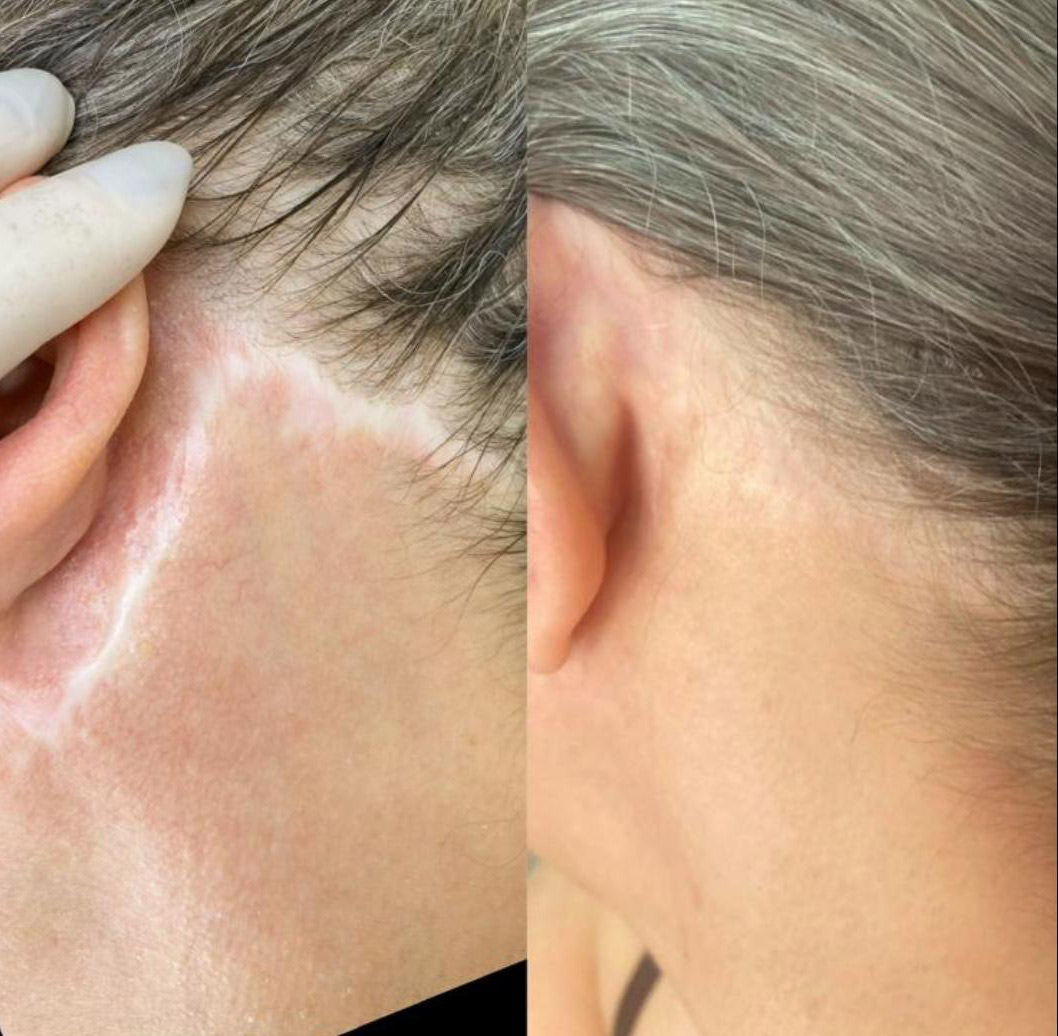 Medizinische Pigmentierung Permanent Make-up Köln - Sara Pavo