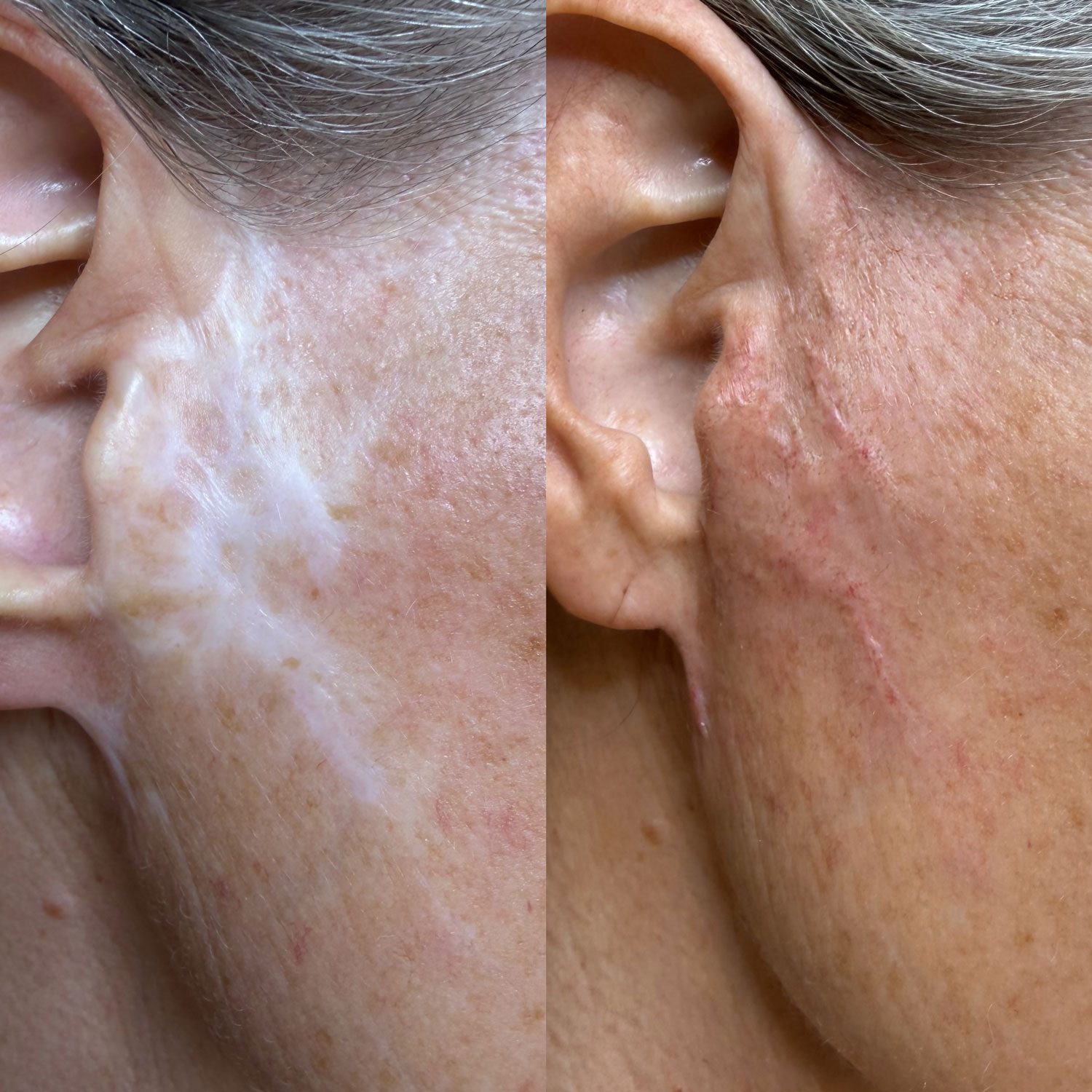Permanent Make-up Fortbildung Narbenpigmentierung Online Kurs | Permanent Make-up Köln - Sara Pavo